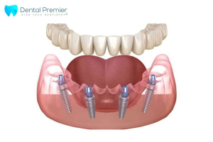 Restaurarea danturii la Dental Premier &icirc;n București: tehnica de implant dentar All on 4 explicată clar
