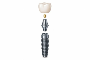 Implant dentar Straumann și adiție osoasă: c&acirc;nd pot fi necesare ambele proceduri