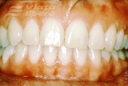Boala gingiilor