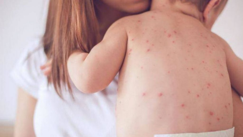 Declararea epidemiei de rujeolă face posibilă  accelerarea campaniei de vaccinare